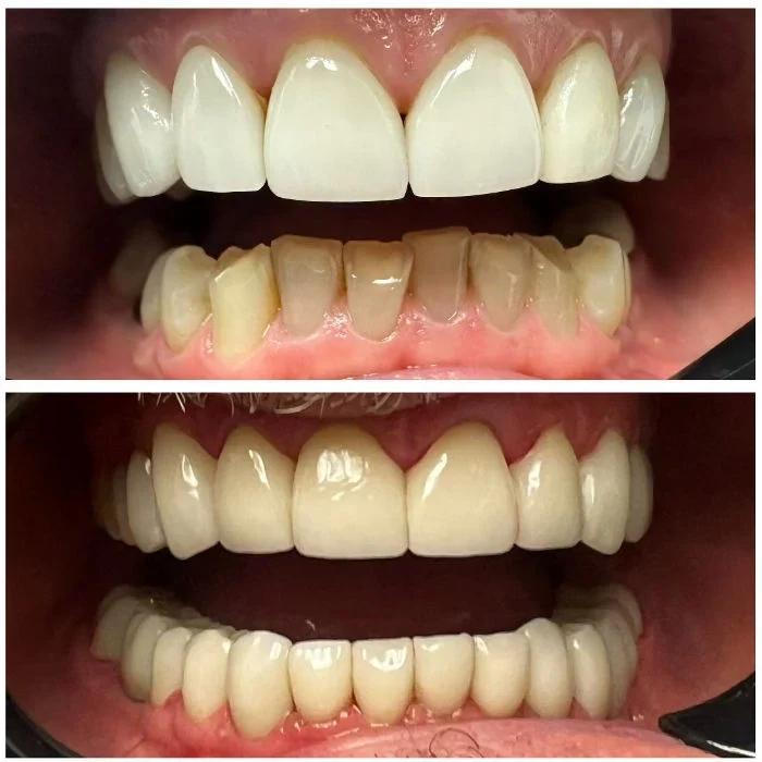 Dental Work Case 5 - Precision Restorative Dentistry